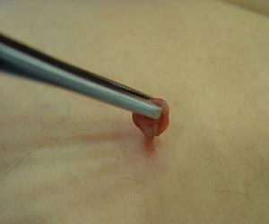 вирус папилломы человека лечение у мужчин