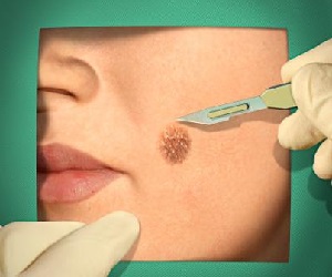 как удалить висячую родинку в домашних условиях