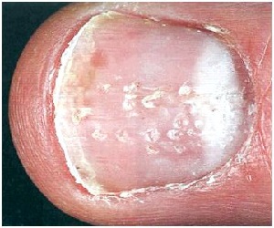 псориаз ногтей пальцев рук фото