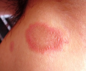 лечение розового лишая у детей
