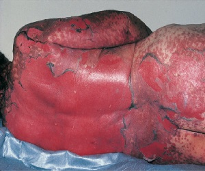 синдром лайелла симптомы