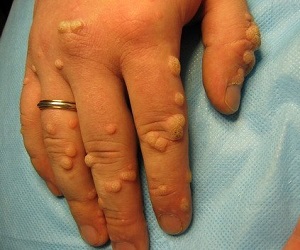 как удалить бородавки на руках