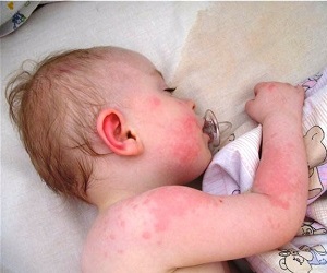 как выглядит пищевая аллергия у детей фото