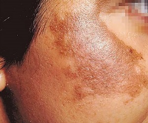 хлоазма на лице фото