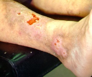 трофическая язва на ноге лечение