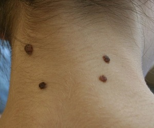 родинки на ухе шее значение