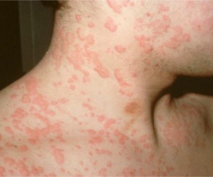 как выглядит крапивница фото у взрослых