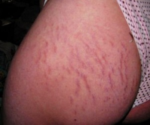 растяжки на ногах фото