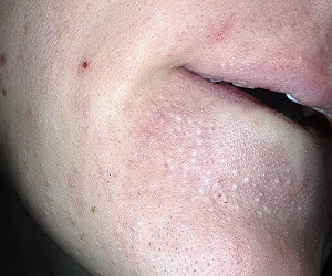 закрытые комедоны на лице лечение