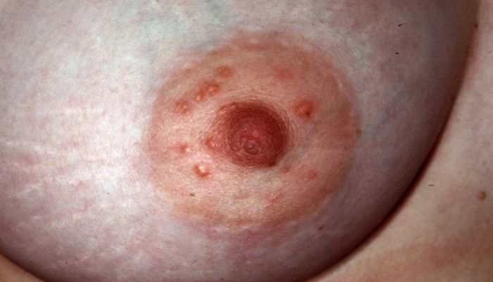 Прыщи на сосках