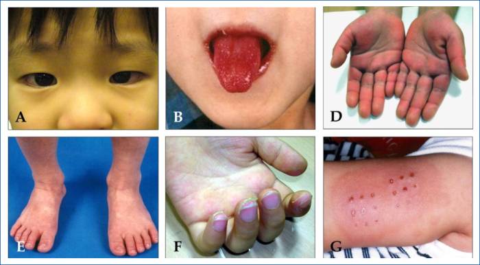 Синдром Кавасаки