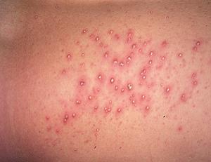 фолликулит фото