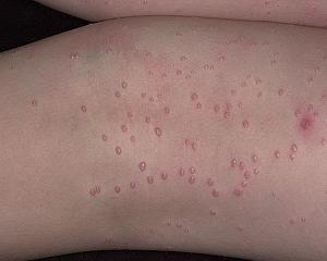 контагиозный моллюск фото у женщин