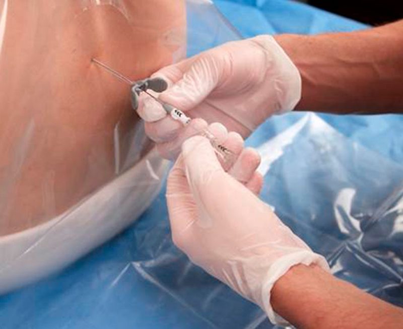 Люмбальная пункция