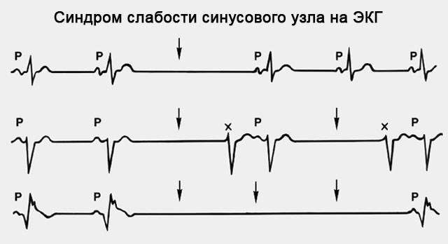 ЭКГ при слабости синусового узла