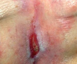 пролежни начальная стадия лечение фото