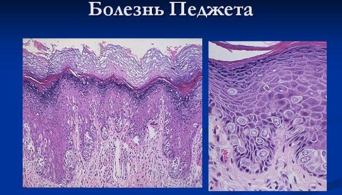 Рак Педжета