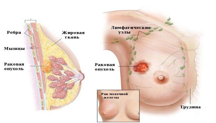 Симптомы РМЖ