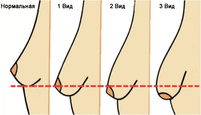 Степени тубулярности