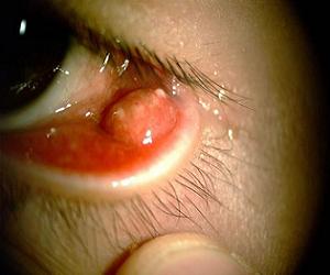 чирей на глазу фото