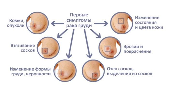 Первые симптомы РМЖ