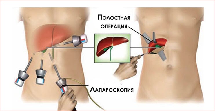 Холецистэктомия