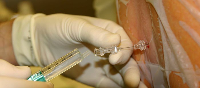 Спинно-мозговая пункция