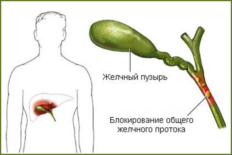 Застой желчи