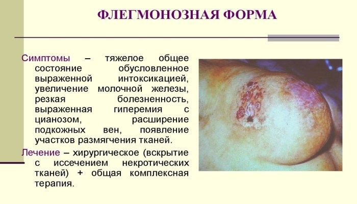 Флегмозный мастит