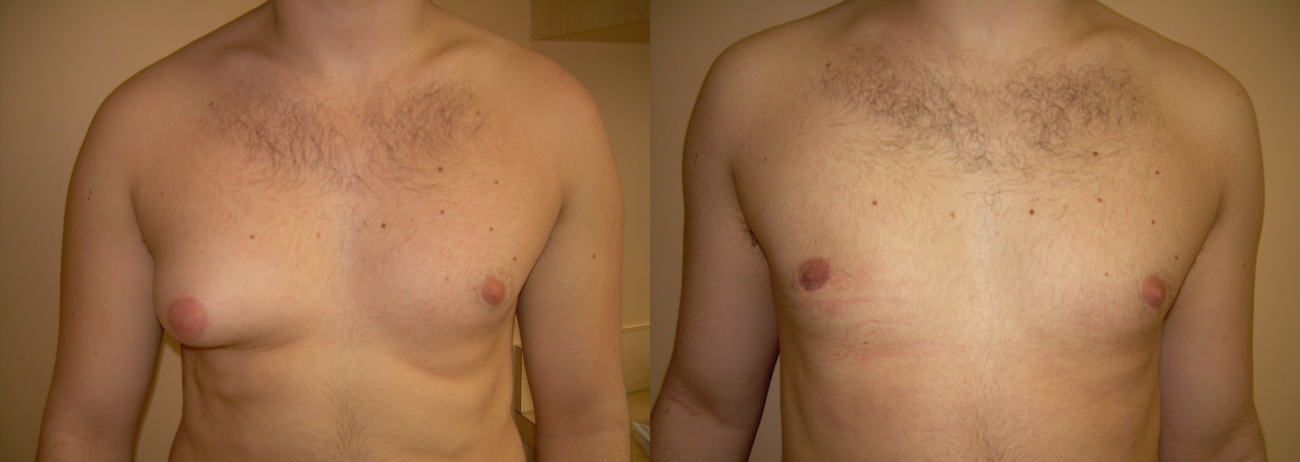 Гинекомастия