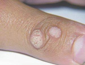 бородавки на пальцах рук фото