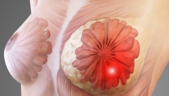 Узелок в МЖ