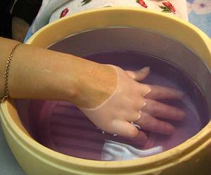 дисгидроз кистей рук лечение фото