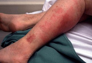 как выглядит рожа на ноге фото