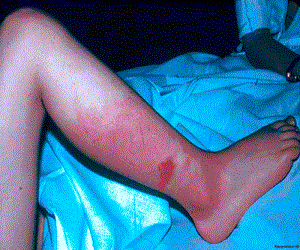 рожа на ноге фото лечение народными средствами