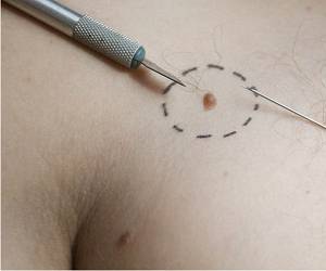 где удалить родинку