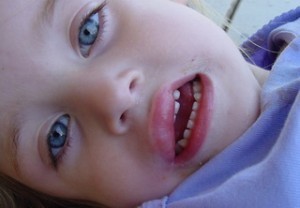 отек квинке фото у детей