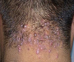 гнойные прыщи на голове фото