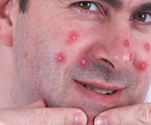 прыщи на щеках что делать