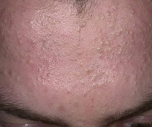 как избавиться от закрытых комедонов