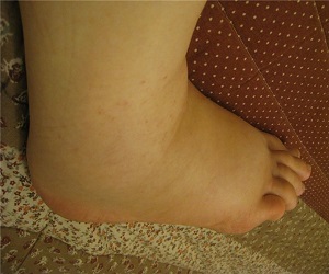 отек стопы ноги у женщин