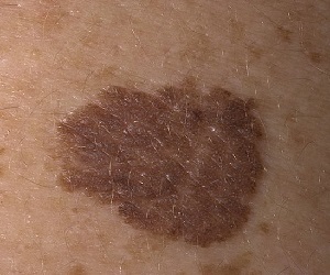 пигментный невус удаление