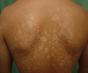 солнечный лишай лечение фото