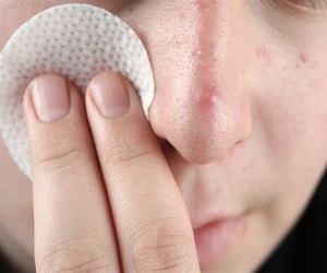 прыщи под носом причины