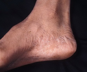 микоз стопы симптомы