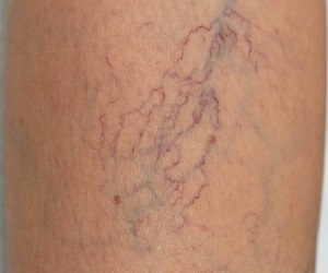 мазь от варикоза