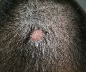 папилломатозный внутридермальный невус