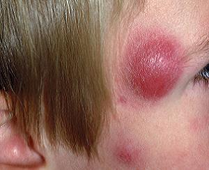 фурункулез причины и лечение фото