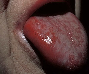 красный плоский лишай в полости рта фото
