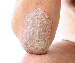 псориаз симптомы лечение фото